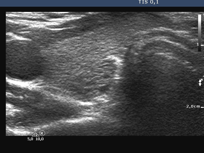 Right lobe, longitudinal scan