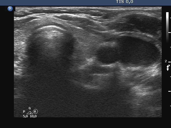 Right lobe, longitudinal scan