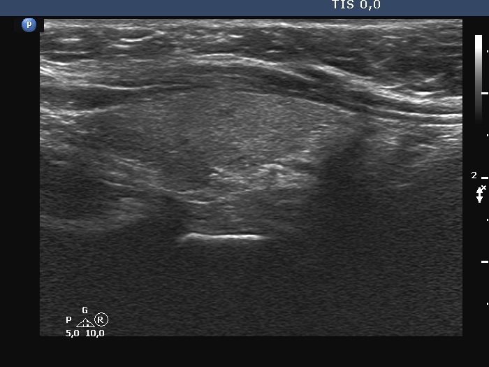 Right lobe, longitudinal scan
