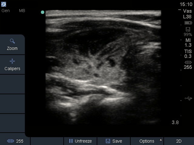 Right lobe, horizontal view