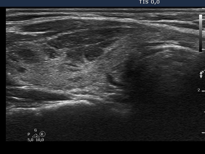 Right lobe, longitudinal scan