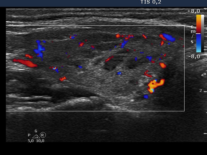 Right lobe, longitudinal scan