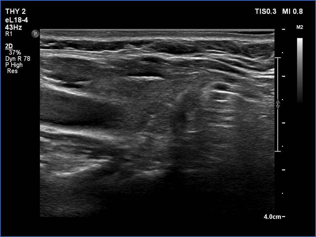 Right lobe, longitudinal scan