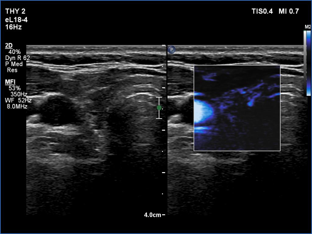 Right lobe, longitudinal scan