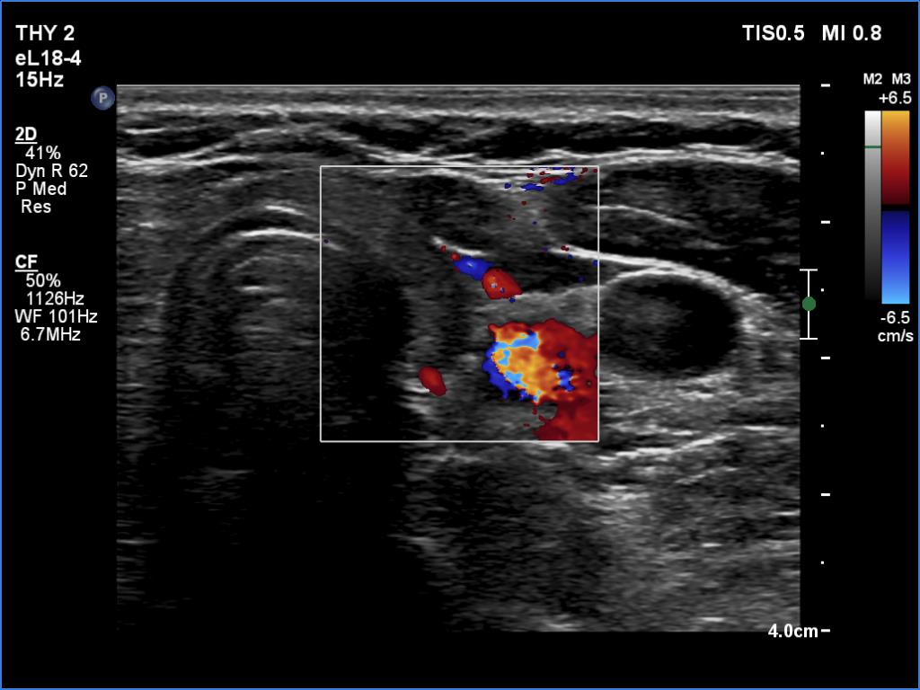 Right lobe, longitudinal scan
