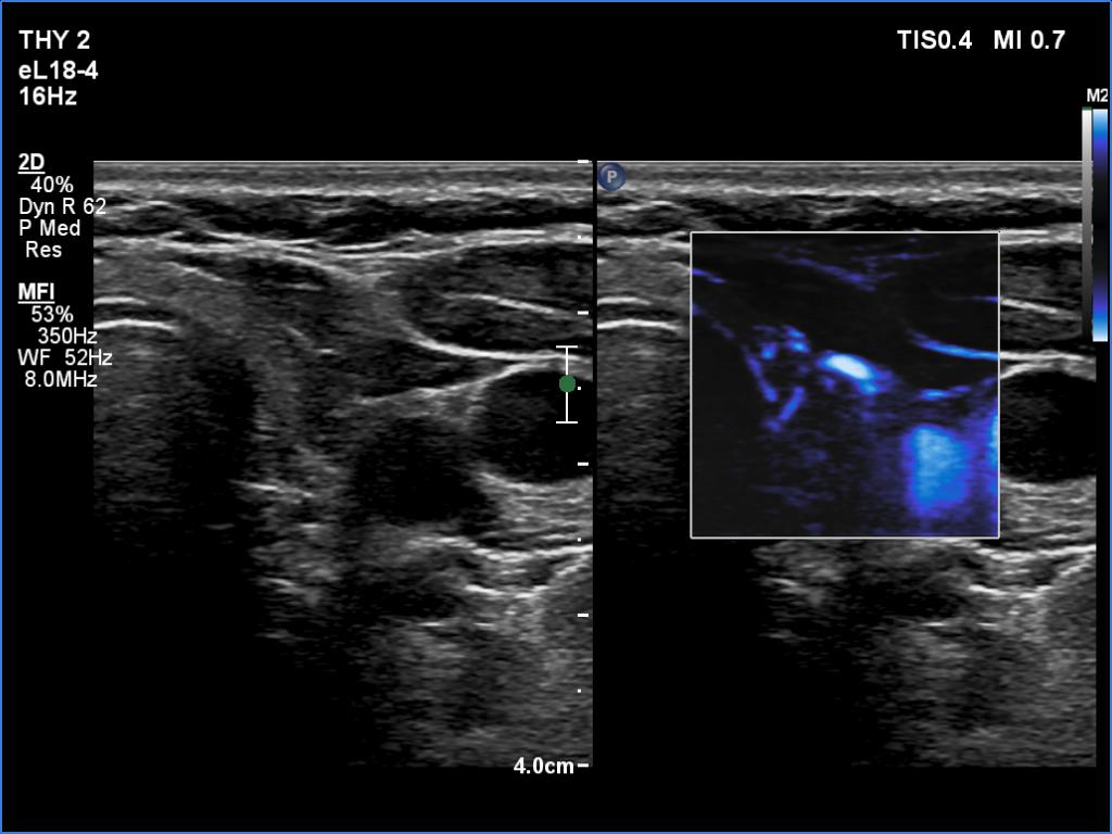 Right lobe, longitudinal scan