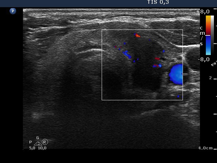 Right lobe, longitudinal scan