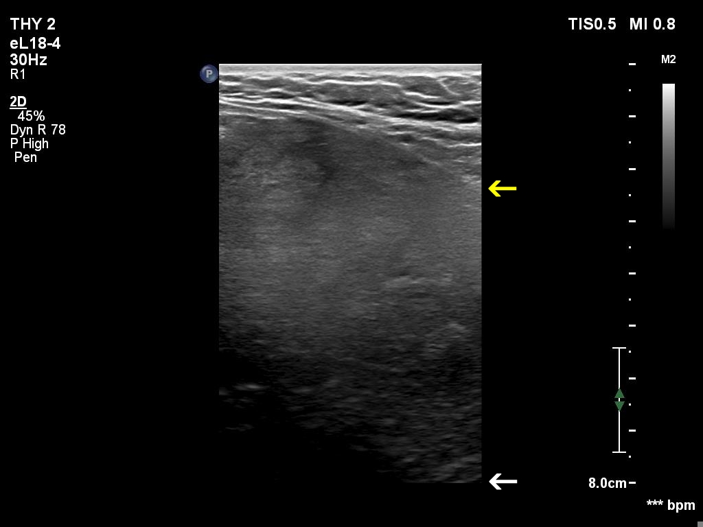 Right lobe, longitudinal scan