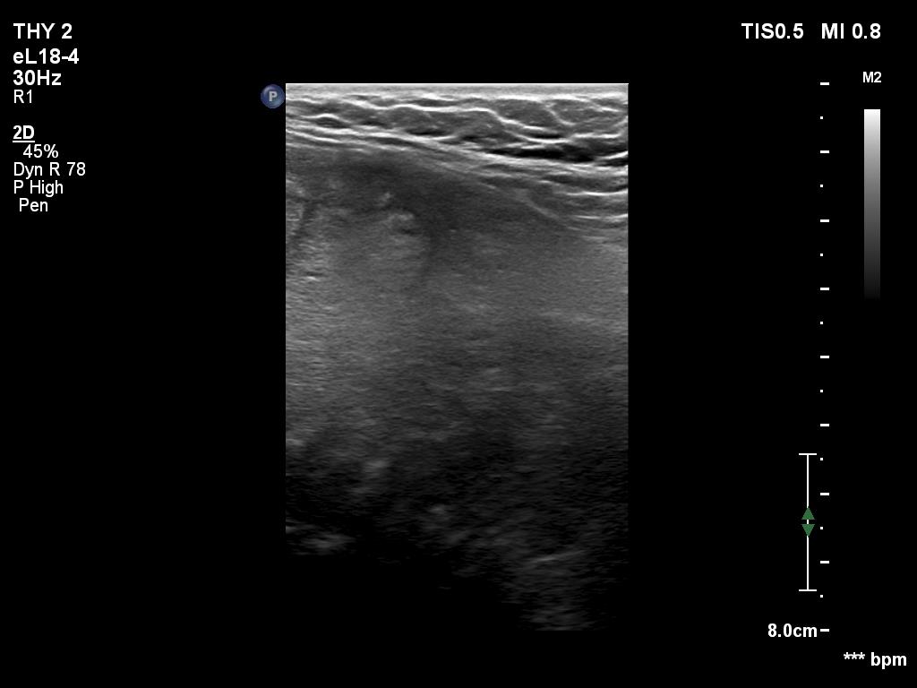 Right lobe, longitudinal scan