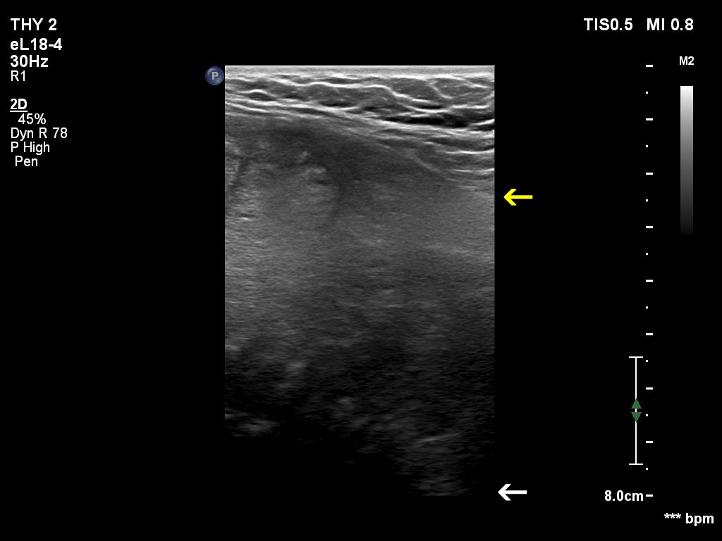 Right lobe, longitudinal scan