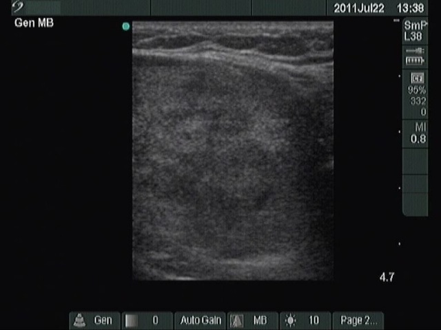 Right lobe, longitudinal scan