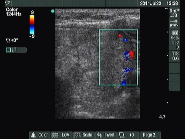 Right lobe, longitudinal scan