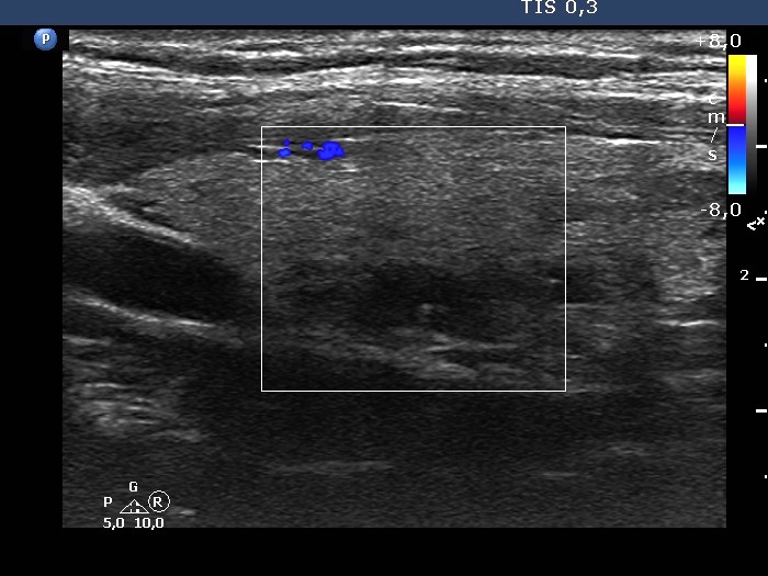 Right lobe, longitudinal scan