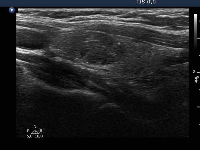 Right lobe, longitudinal scan