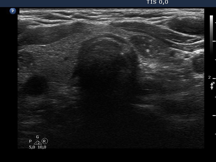 Right lobe, longitudinal scan