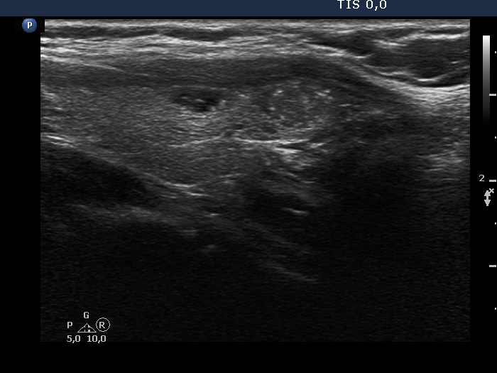Right lobe, longitudinal scan