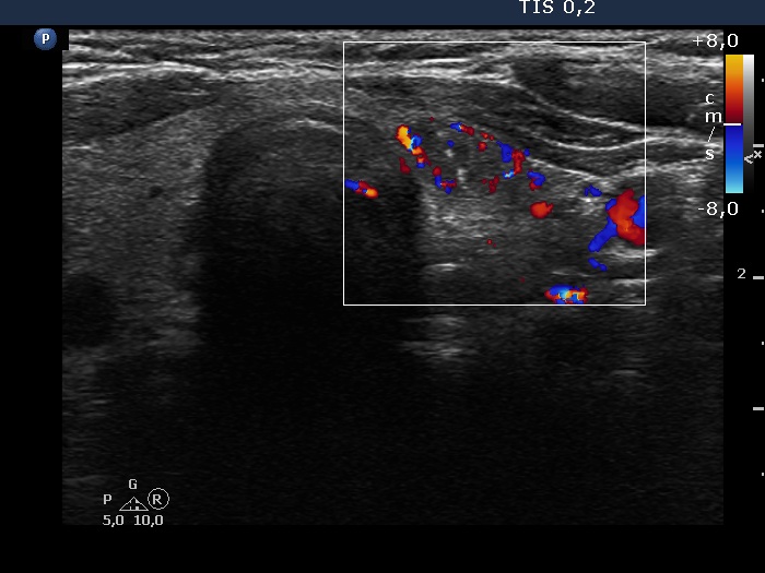 Right lobe, longitudinal scan