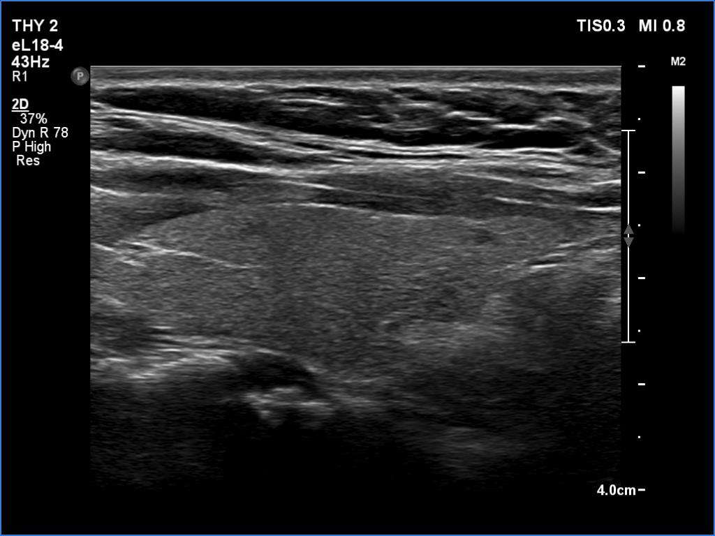 Right lobe, longitudinal scan