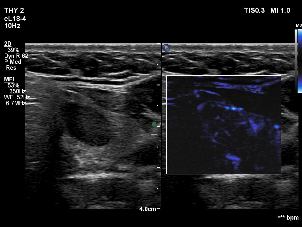 Right lobe, longitudinal scan