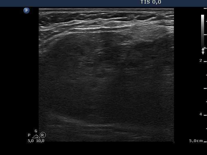 Right lobe, longitudinal scan