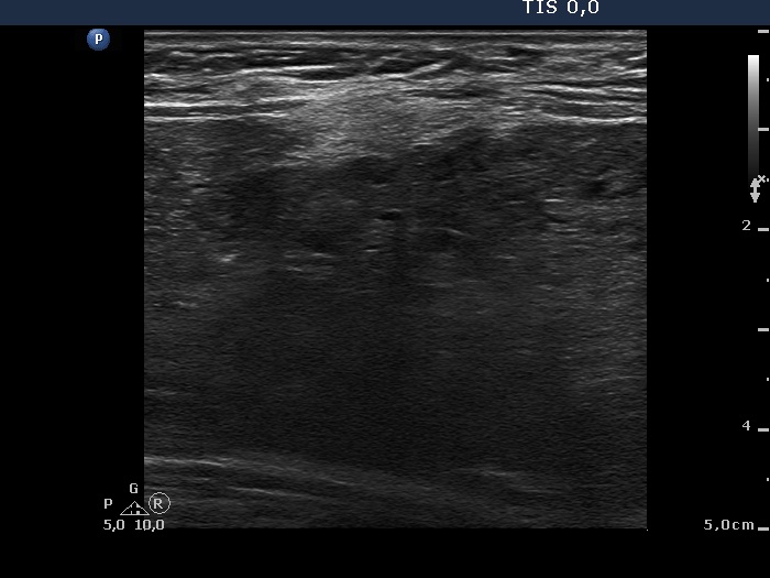 Right lobe, longitudinal scan