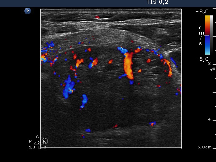 Right lobe, longitudinal scan