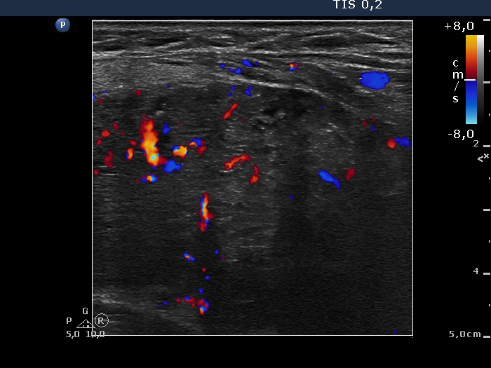 Right lobe, longitudinal scan