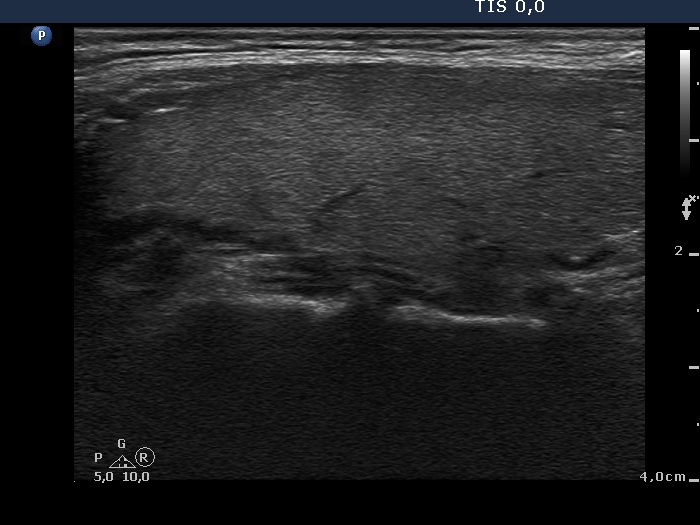 Right lobe, longitudinal scan