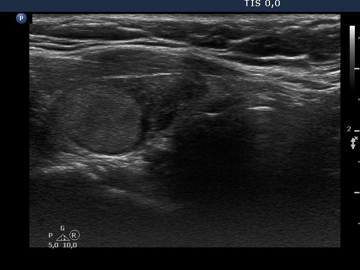 Right lobe, longitudinal scan