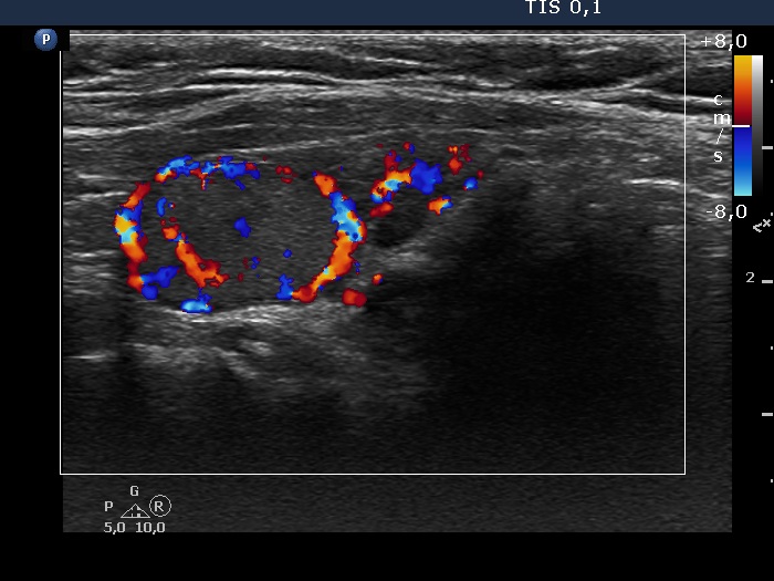 Right lobe, longitudinal scan