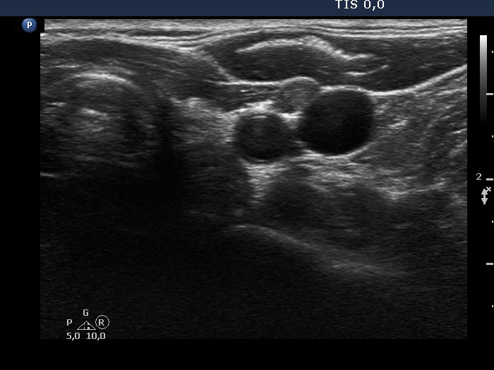 Right lobe, longitudinal scan
