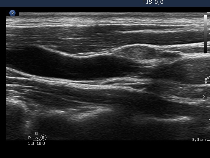 Right lobe, longitudinal scan