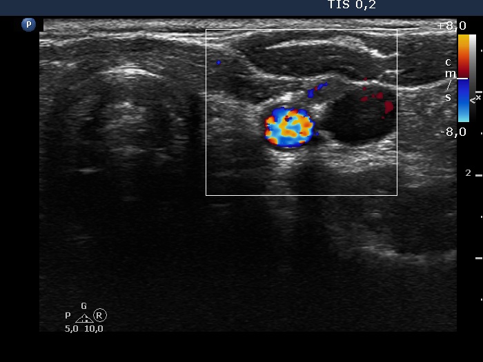 Right lobe, longitudinal scan