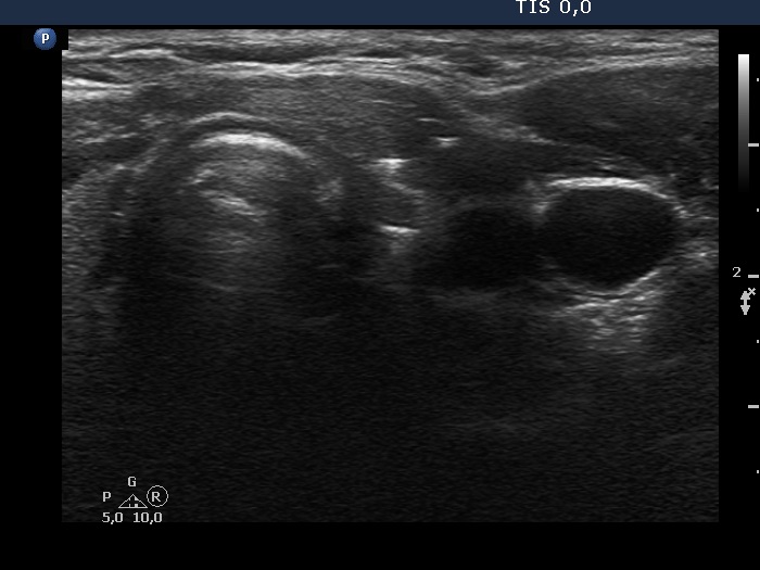 Right lobe, longitudinal scan