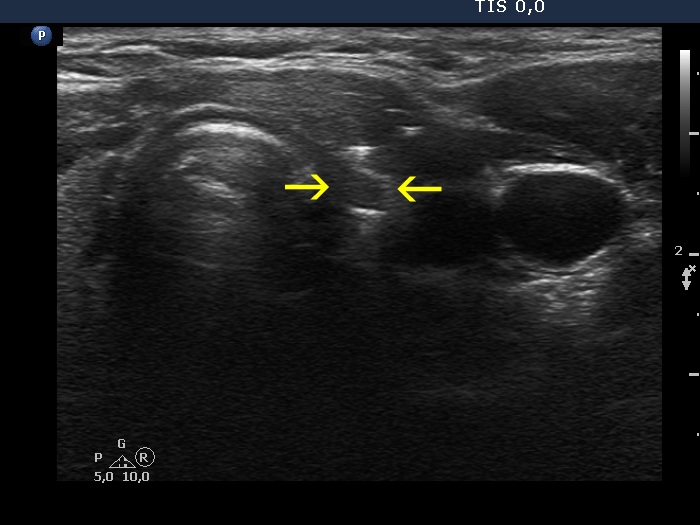 Right lobe, longitudinal scan