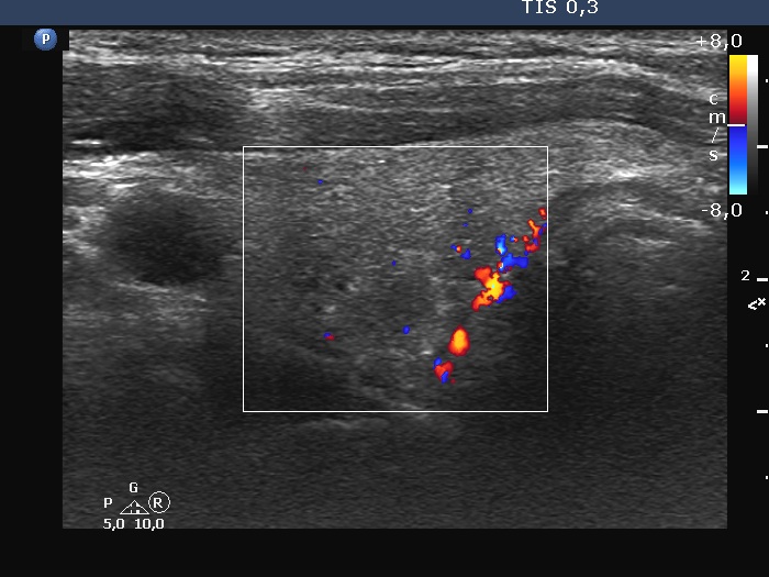 Right lobe, longitudinal scan