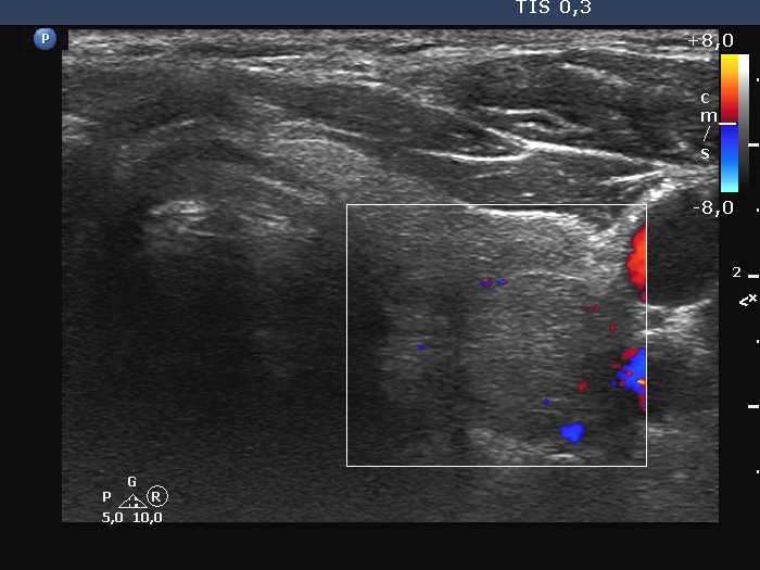 Right lobe, longitudinal scan