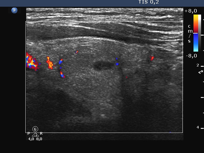 Right lobe, longitudinal scan