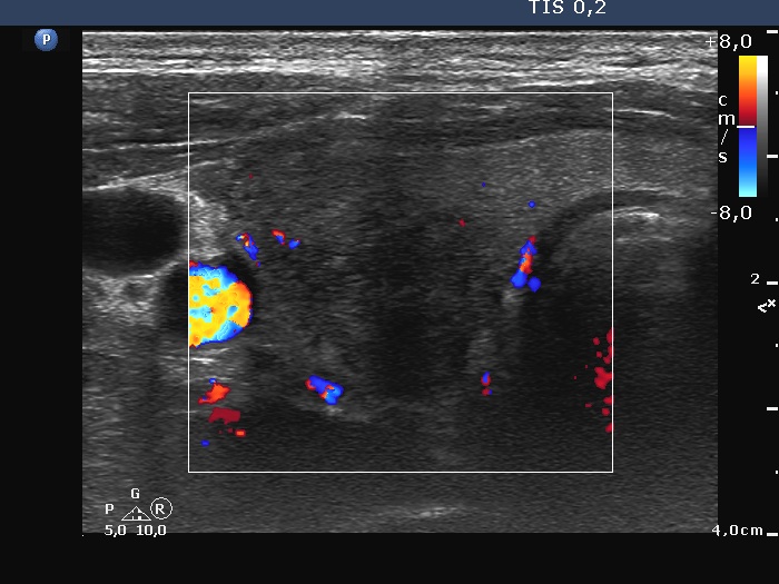 Right lobe, longitudinal scan