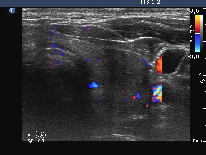 Right lobe, longitudinal scan