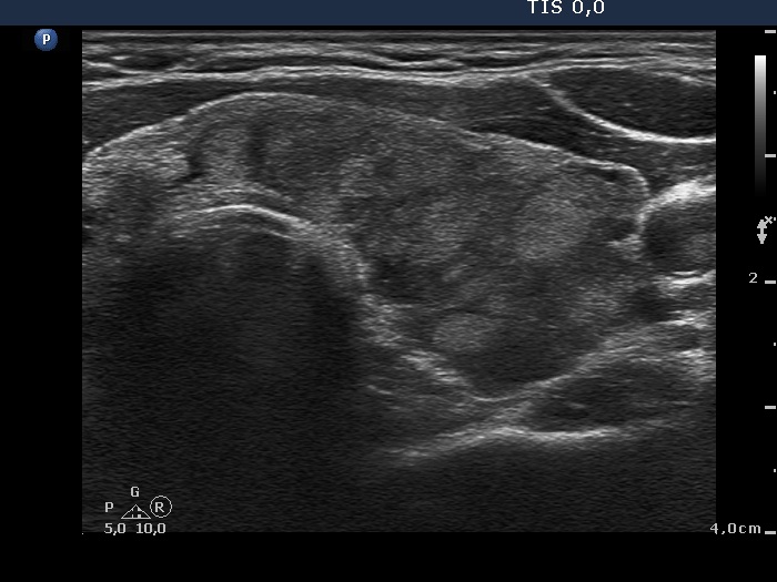 Right lobe, longitudinal scan