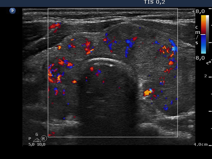 Right lobe, longitudinal scan