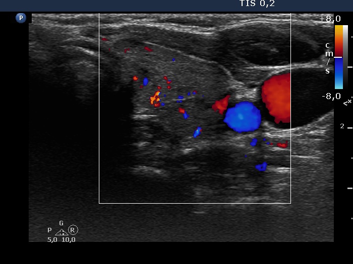 Right lobe, longitudinal scan