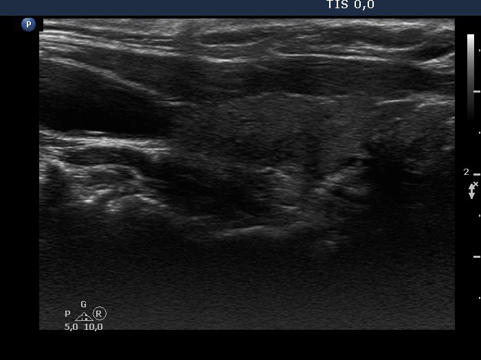 Right lobe, longitudinal scan