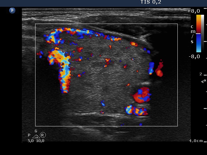 Right lobe, longitudinal scan