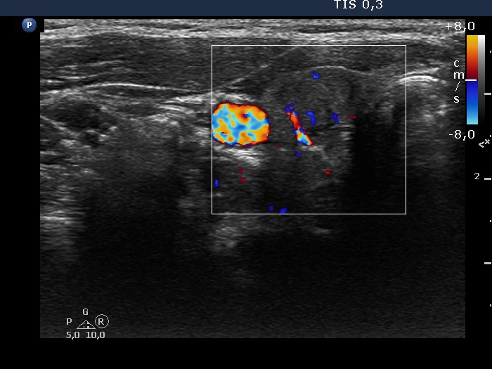 Right lobe, longitudinal scan