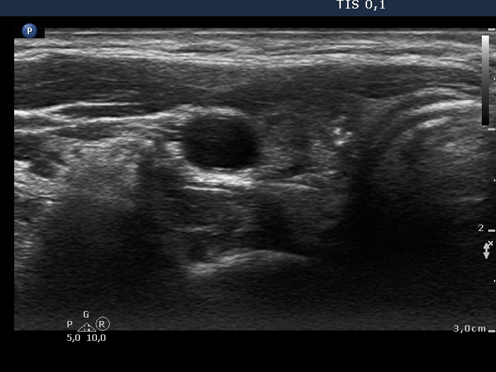 Right lobe, longitudinal scan