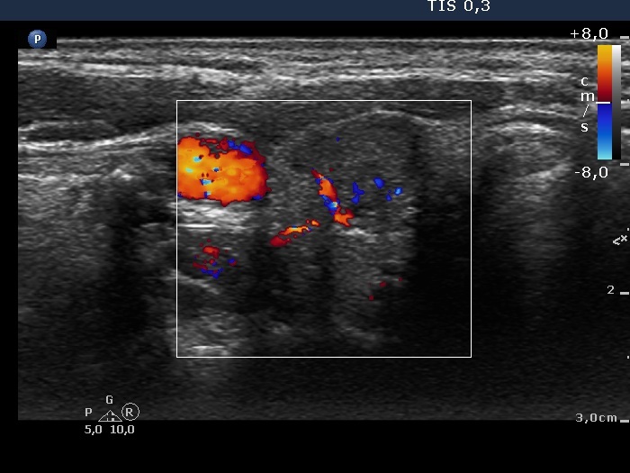 Right lobe, longitudinal scan