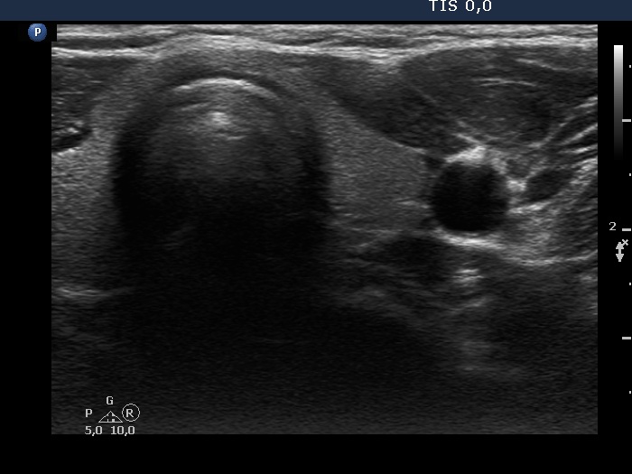 Right lobe, longitudinal scan