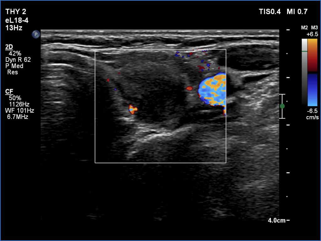 Right lobe, longitudinal scan